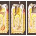 Гангренозный пульпит: формы, их особенности, диагностика и лечение