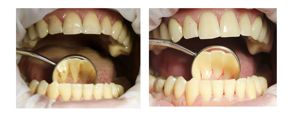 Удаление зубного налета и камней ультразвуковой чисткой