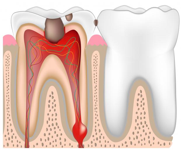 Некроз пульпы