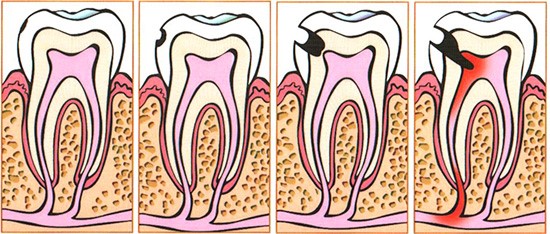 Причины возникновения пульпита - фото 2